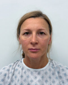 Эндоскопическая подтяжка лица - до