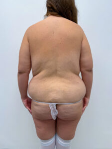 Нижний бодилифт - до