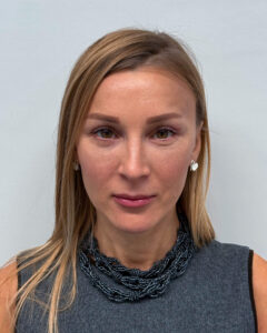 Эндоскопическая подтяжка лица - после