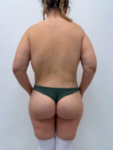 Нижний бодилифт - после