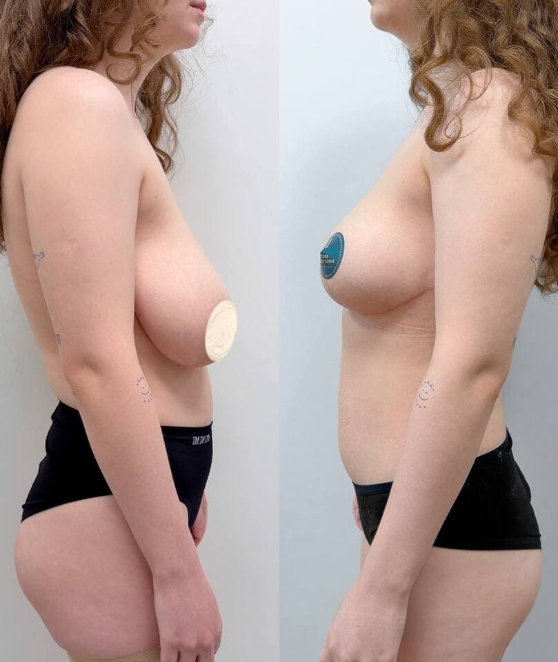 Результаты редукционной маммопластики. Хирург Халилуллин Р.И.