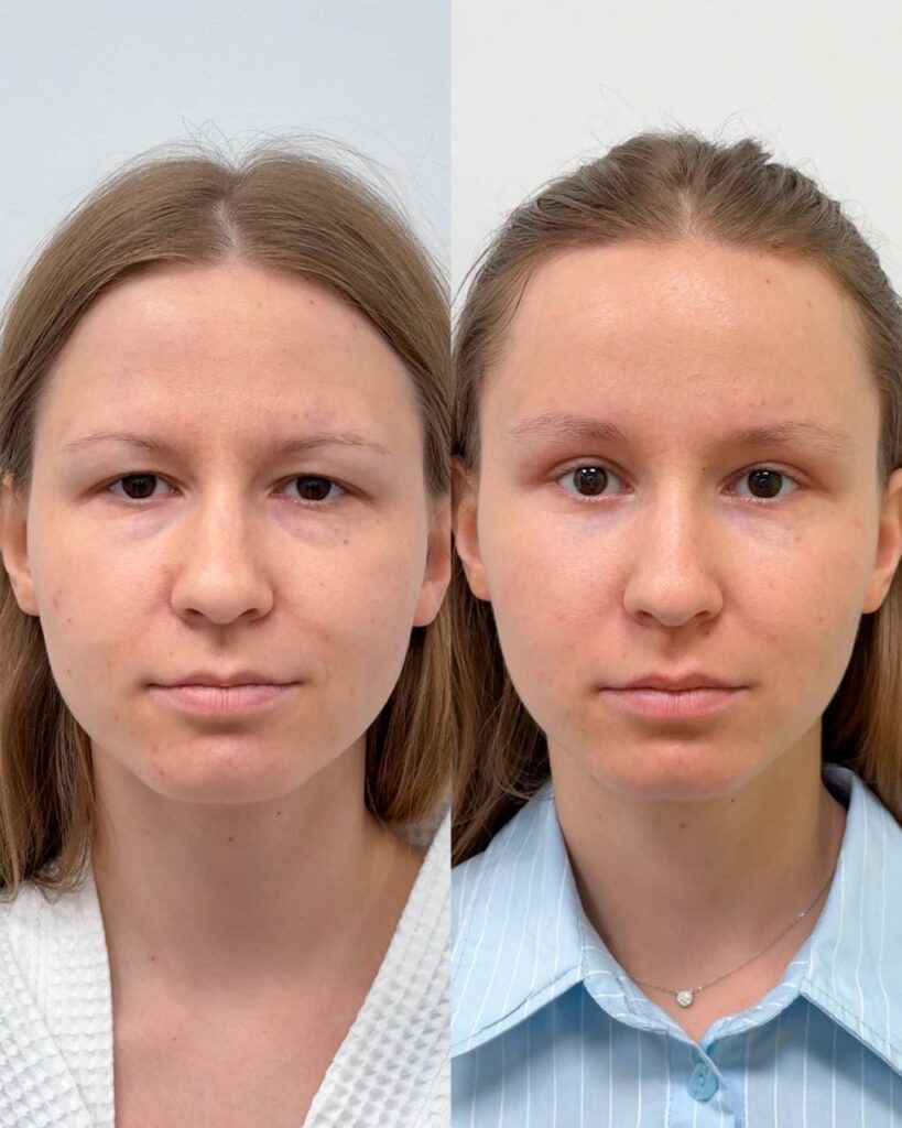 Эндоскопический лифтинг. Фото до и после. Хирург Халилуллин Р.И.