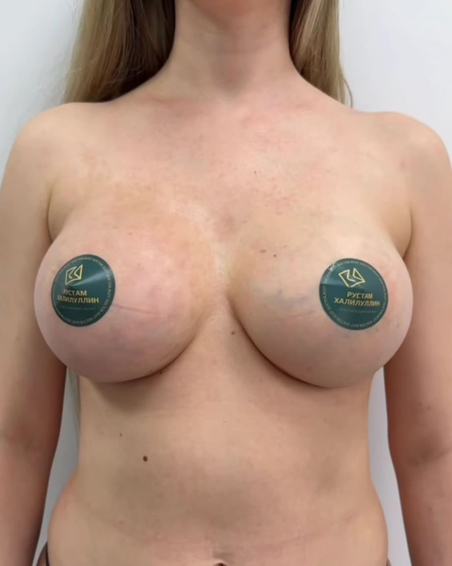 Хирург Халилуллин Р.И. Результат увеличения молочных желез.