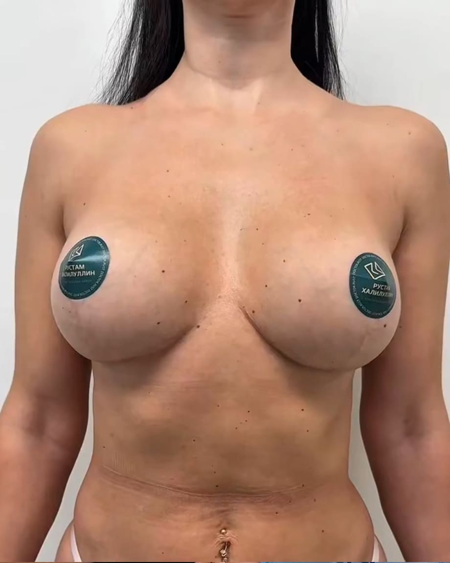 Увеличение груди через 3,5 года после. Хирург Халилуллин Р.И.