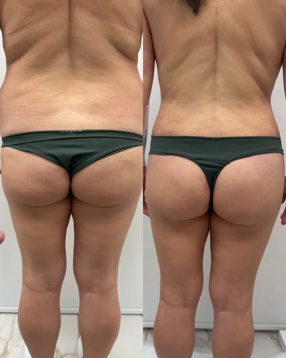 Бодилифт с липомоделированием ягодиц. Вид со спины. Халилуллин Р.И.