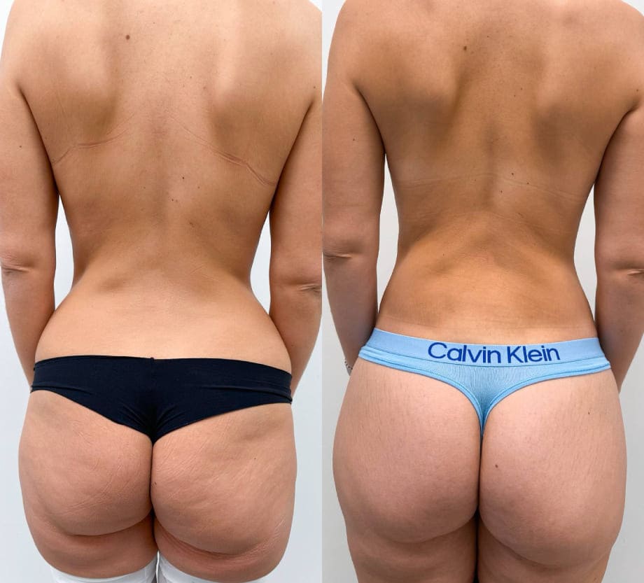 Пример бодилифта. Вид со спины. Хирург Халилуллин Р.И.