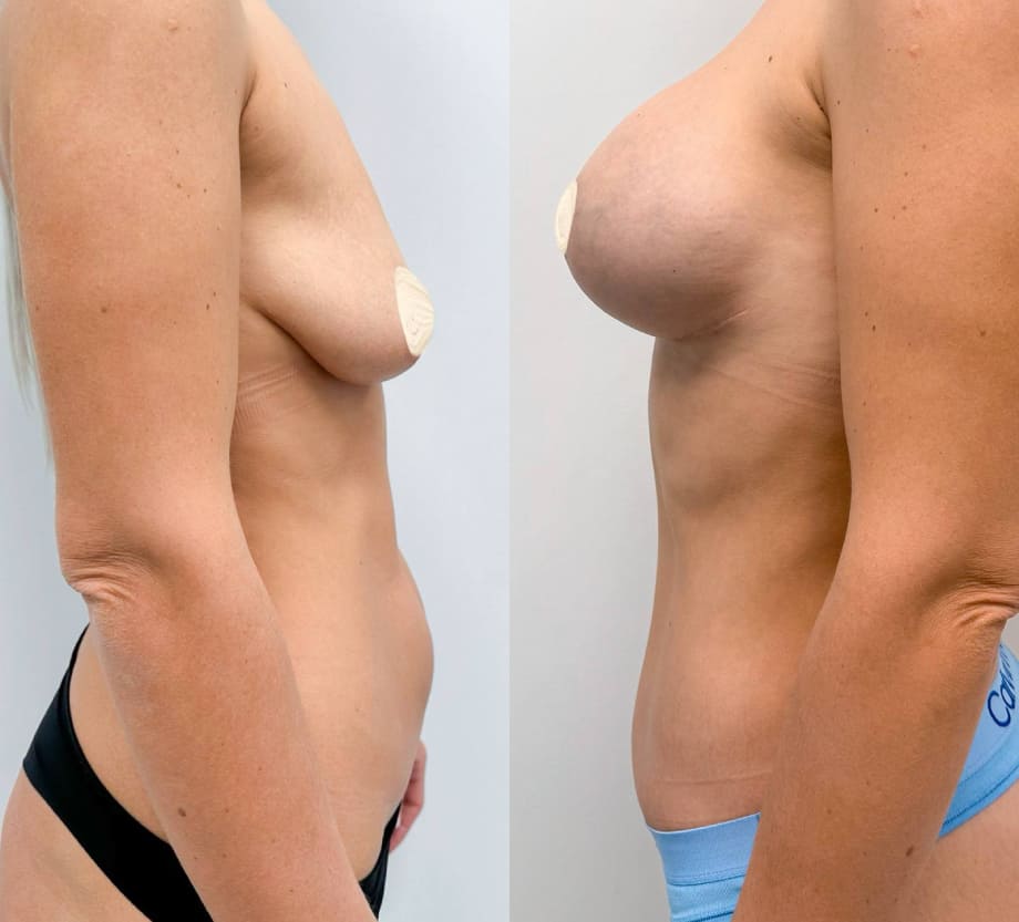 Пример бодилифта с подтяжкой груди. Вид сбоку. Хирург Халилуллин Р.И.