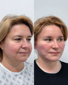 Тотальный фейслифтинг. До и после. Хирург Халилуллин Р.И.
