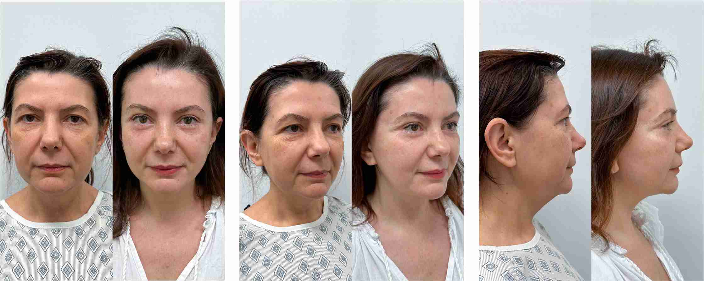 фото до и после тотального омоложения лица